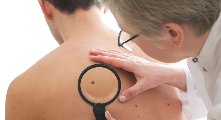 Câncer de pele: conheça os sintomas e como se cuidar